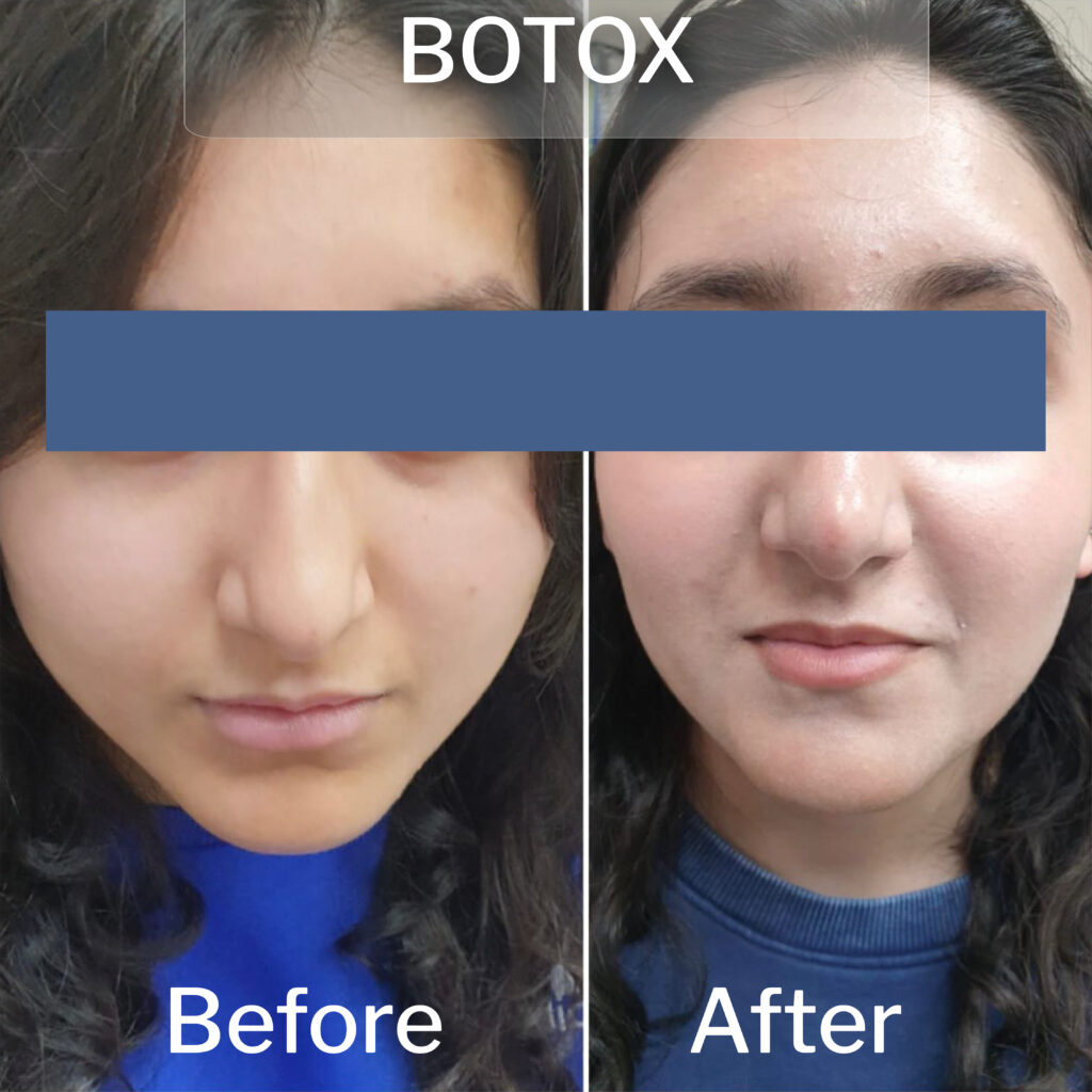 Best Botox Injections in Rawalpindi before and after