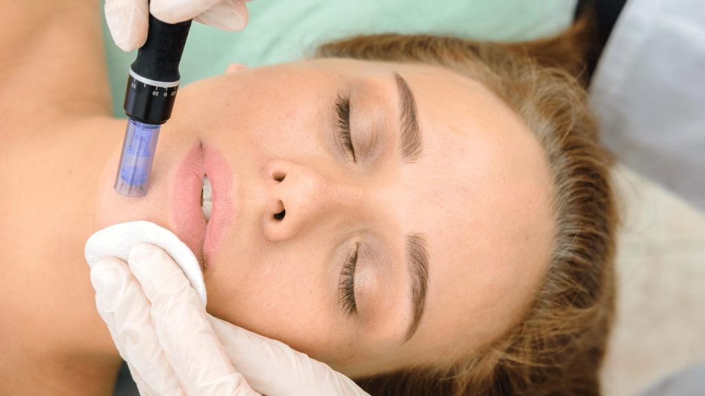 Best Microneedling Treatment in Rawaslpindi